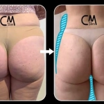 CmSlim, τεχνολογία υψηλής έντασης ηλεκτρομαγνητικής εκγύμνασης μυών