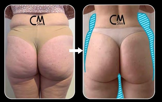 CmSlim, τεχνολογία υψηλής έντασης ηλεκτρομαγνητικής εκγύμνασης μυών