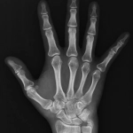 AeroDR 3 1417HL, Wireless Digital Radiography System