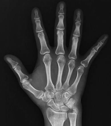 AeroDR 3 1417HL, Wireless Digital Radiography System