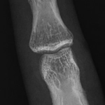 AeroDR 3 1417HL, Wireless Digital Radiography System