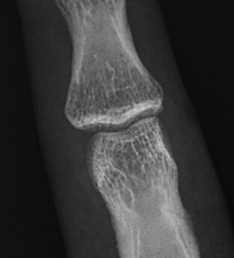 AeroDR 3 1417HL, Wireless Digital Radiography System