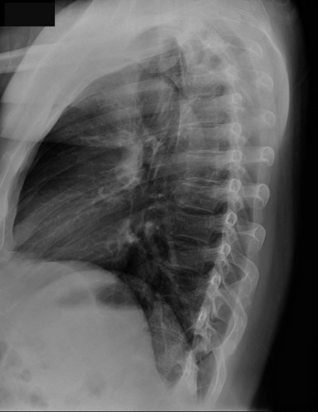 AeroDR 3 1417HL, Wireless Digital Radiography System