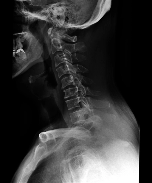 AeroDR 3 1417HL, Wireless Digital Radiography System