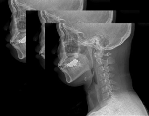 AeroDR TX, Φορητό Ψηφιακό Ηλεκτροκίνητο Ακτινολογικό Σύστημα