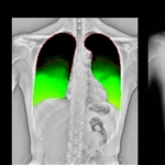 AeroDR TX, Φορητό Ψηφιακό Ηλεκτροκίνητο Ακτινολογικό Σύστημα