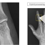 AeroDR 3 1417SL, Wireless Digital Radiography System
