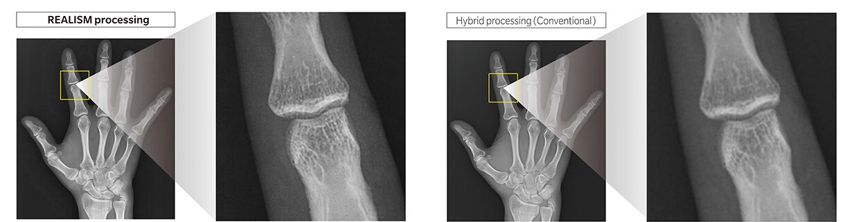AeroDR 3 1417SL, Wireless Digital Radiography System