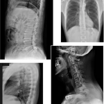 AeroDR 3 1417SL, Wireless Digital Radiography System