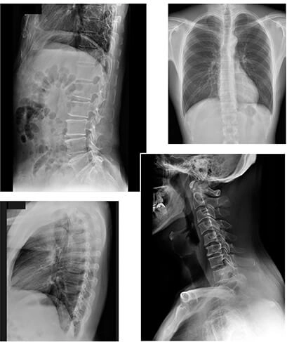 AeroDR 3 1417SL, Wireless Digital Radiography System