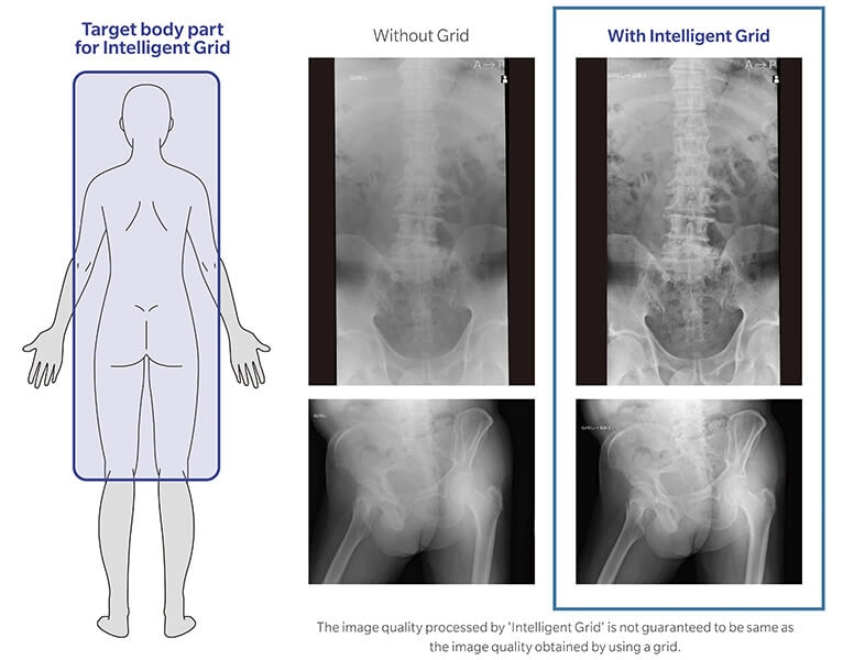 AeroDR 3 1417SL, Wireless Digital Radiography System