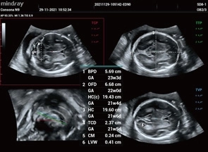 Υπέρηχος Mindray Consona N9