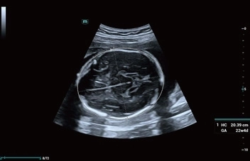 Υπέρηχος Mindray Consona N9