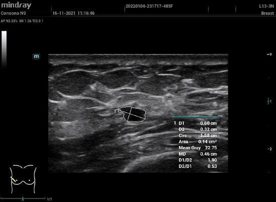 Υπέρηχος Mindray Consona N9
