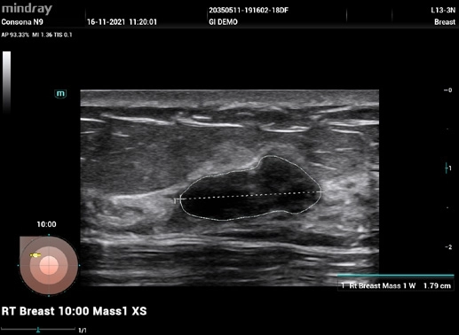 Υπέρηχος Mindray Consona N9