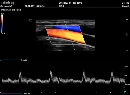 Υπέρηχος Mindray Consona N9
