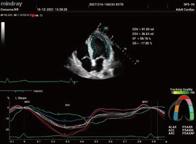 Υπέρηχος Mindray Consona N9
