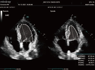 Υπέρηχος Mindray Consona N9