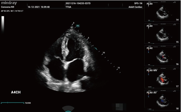 Υπέρηχος Mindray Consona N9