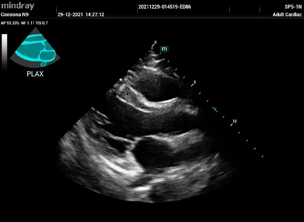 Υπέρηχος Mindray Consona N9