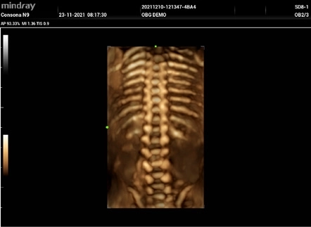 Υπέρηχος Mindray Consona N9