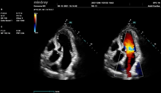 Υπέρηχος Mindray Consona N9