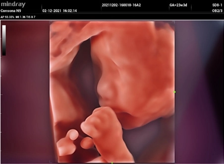 Υπέρηχος Mindray Consona N9