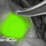 System green – Σύστημα φθορίζουσας απεικόνισης ICG/NIR