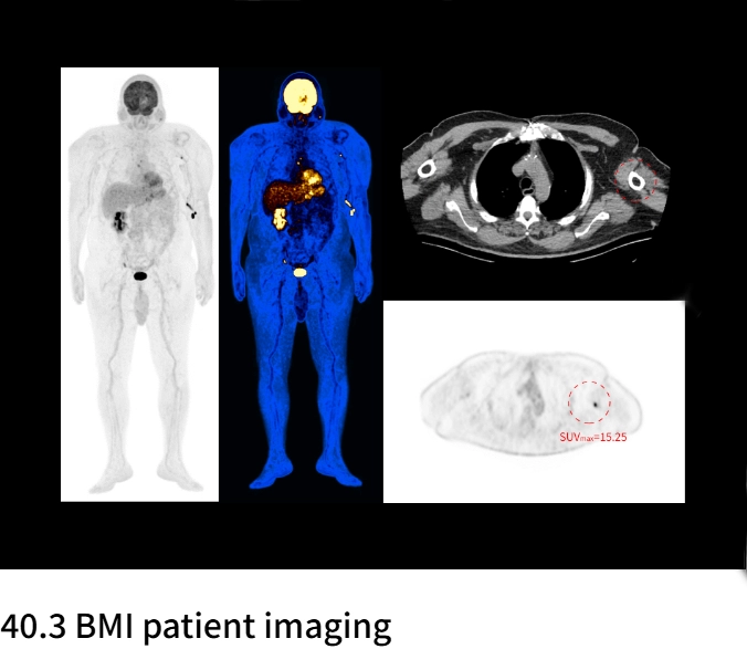 uMI Vista| Digital High-Resolution PET/CT