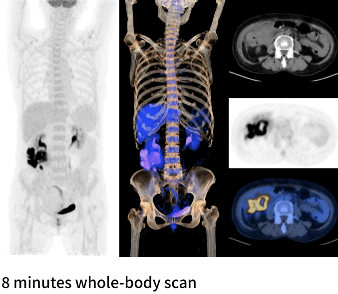 uMI Vista| Digital High-Resolution PET/CT