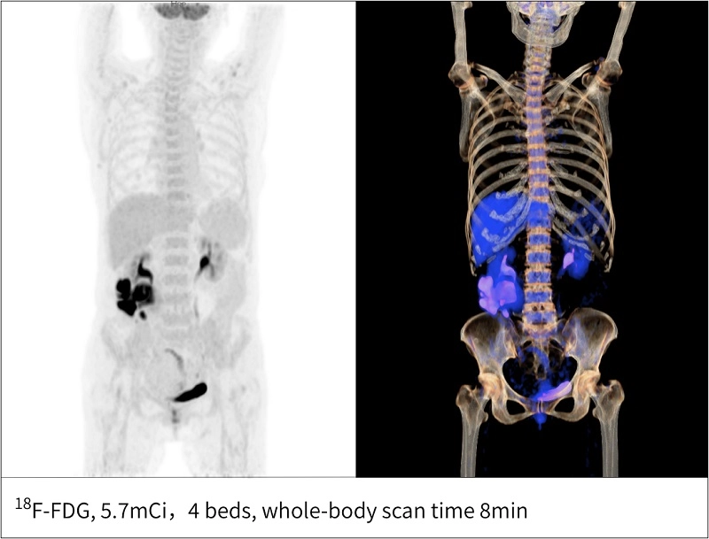 uMI Vista| Digital High-Resolution PET/CT